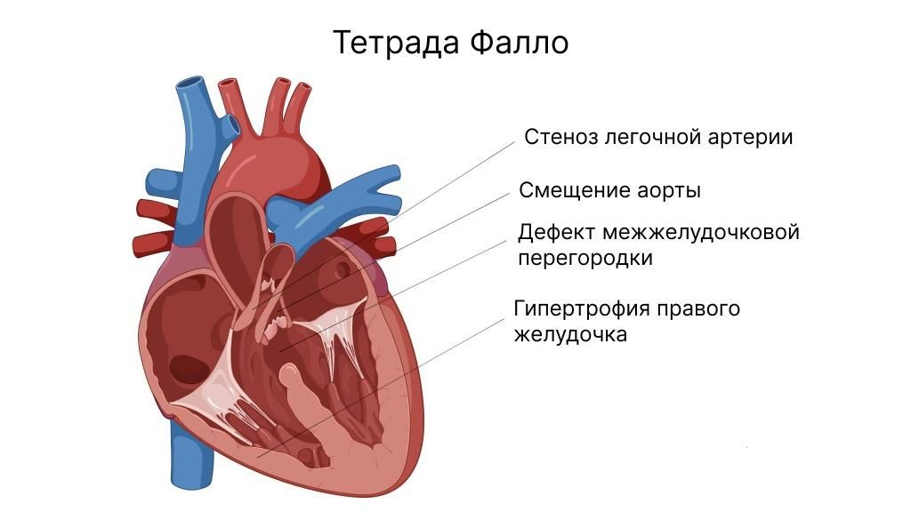 Дефекты при тетраде Фалло