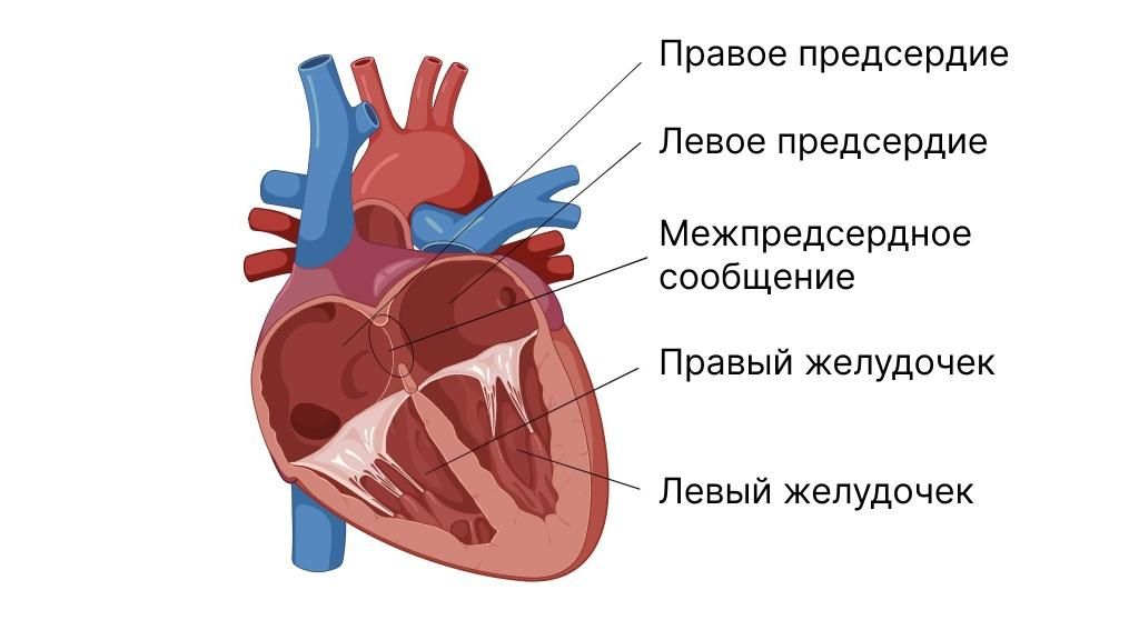 Межпредсердное сообщение у детей - симптомы