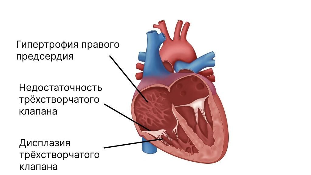 Симптомы и лечение аномалии Эбштейна