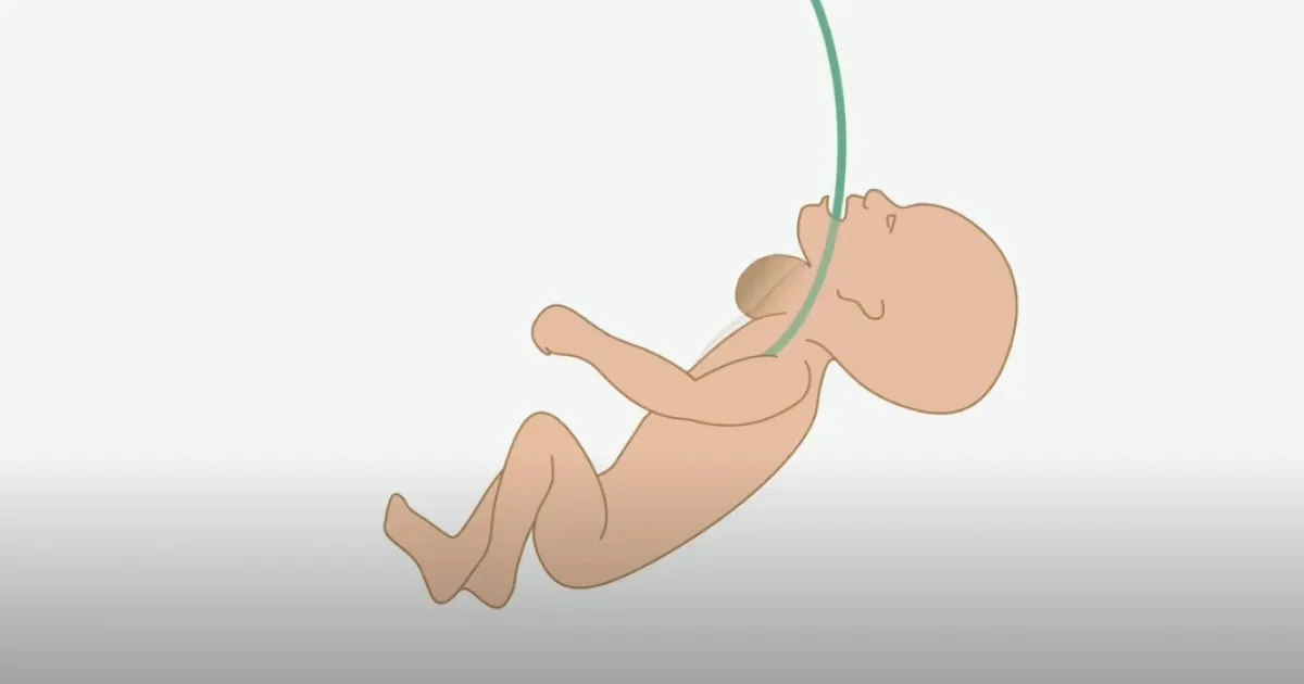 Explanatory video of BCNatal fetal surgeries for face and neck tumors Explanatory video of BCNatal fetal surgeries for face and neck tumors
